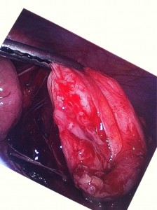 zach's infected appendix my infected appendix